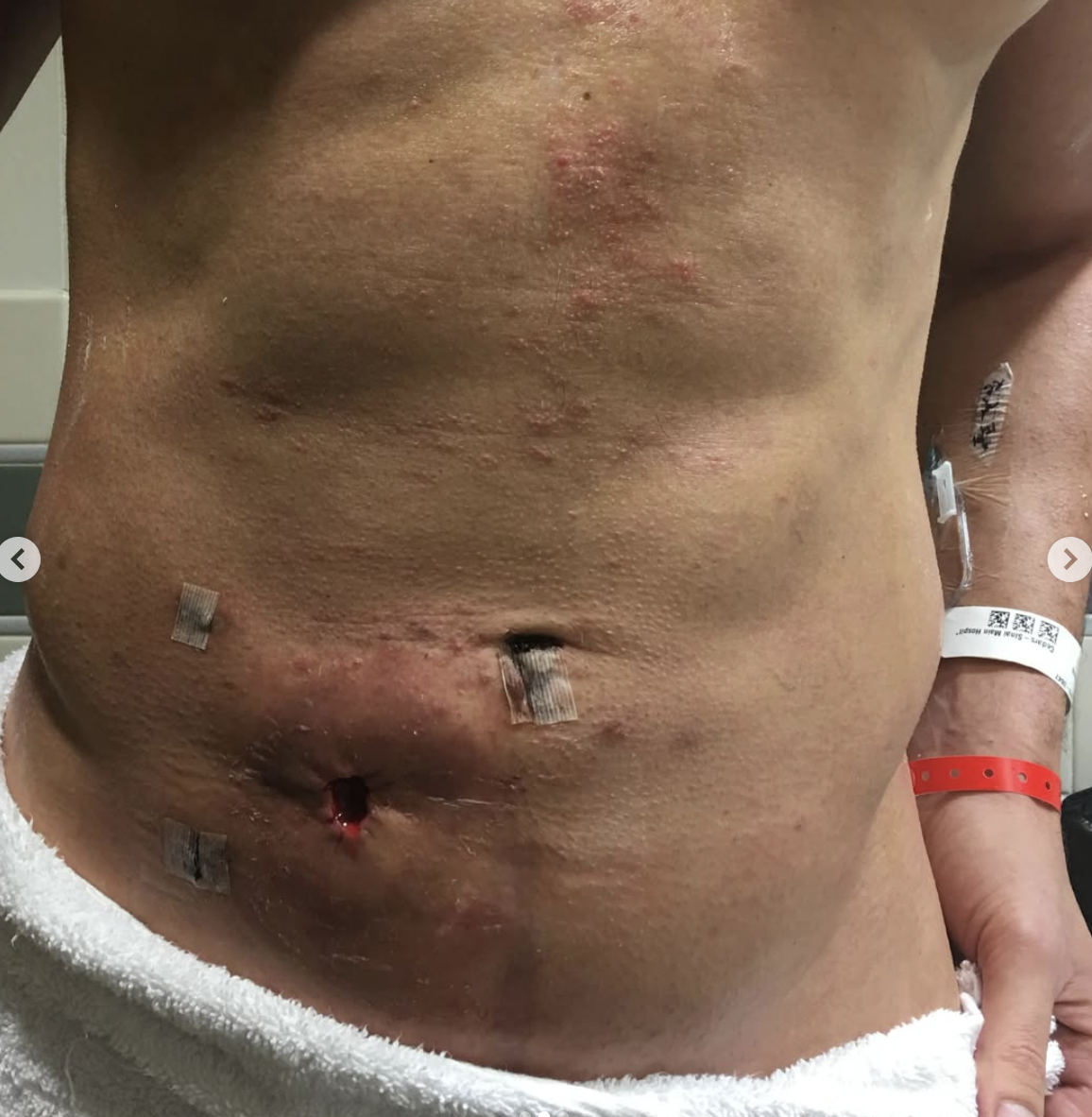Joe Manganiello torso digestive track surgery